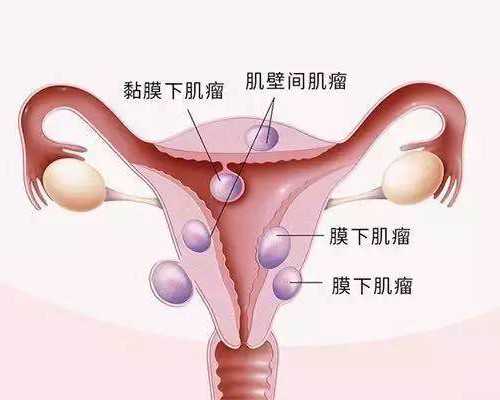 做试管促排卵穿刺子宫吗